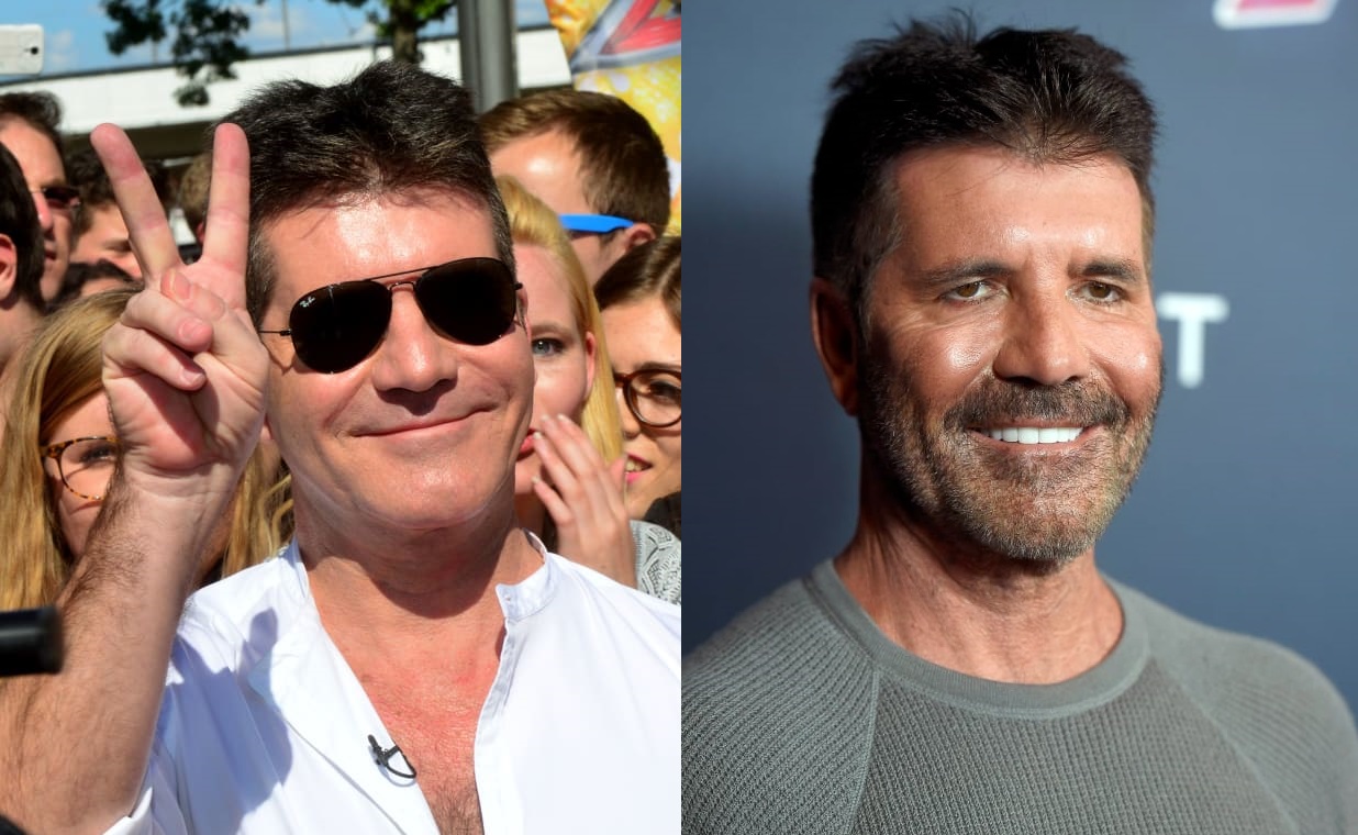 simon cowell plastic surgery