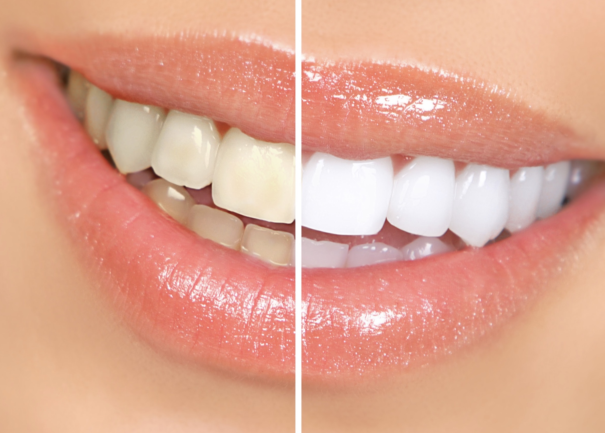 Teeth Whitening 3 DentistApproved Ways To Whiten Your Teeth