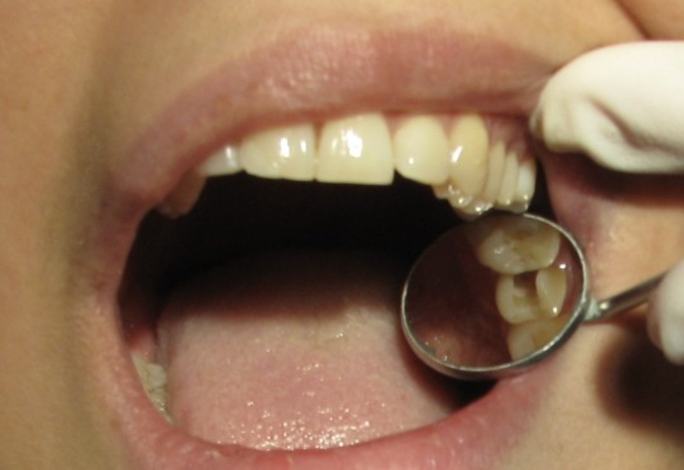 9 Important Root Canal Recovery Tips