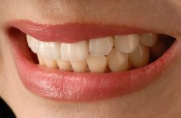 asian smile, anterior teeth, veneer